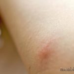 piqure-moustique-0
